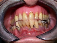 /album/galeria-de-fotos-overdenture/overdenture1-jpg/