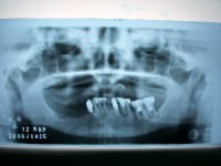/album/galeria-de-fotos-overdenture/overdenture2-jpg/