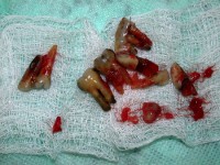 /album/galeria-de-fotos-overdenture/overdenture3-jpg/