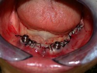 /album/galeria-de-fotos-overdenture/overdenture4-jpg/