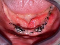 /album/galeria-de-fotos-overdenture/overdenture5-jpg/