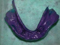 /album/galeria-de-fotos-overdenture/overdenture6-jpg/