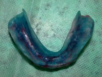 /album/galeria-de-fotos-overdenture/overdenture7-jpg/