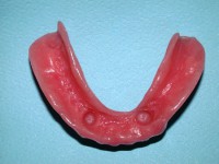 /album/galeria-de-fotos-overdenture/overdenture8-jpg/