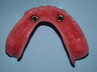 /album/galeria-de-fotos-overdenture/overdenture9-jpg/