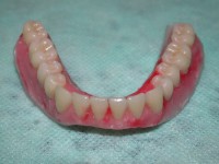 /album/galeria-de-fotos-overdenture/overdenture10-jpg/