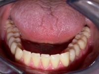 /album/galeria-de-fotos-overdenture/overdenture12-jpg/